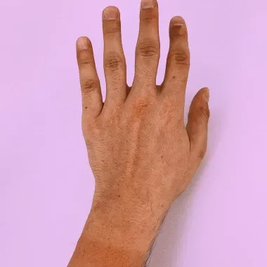 Nieuw: Spreekuur voor beoordelen plekjes en vlekjes